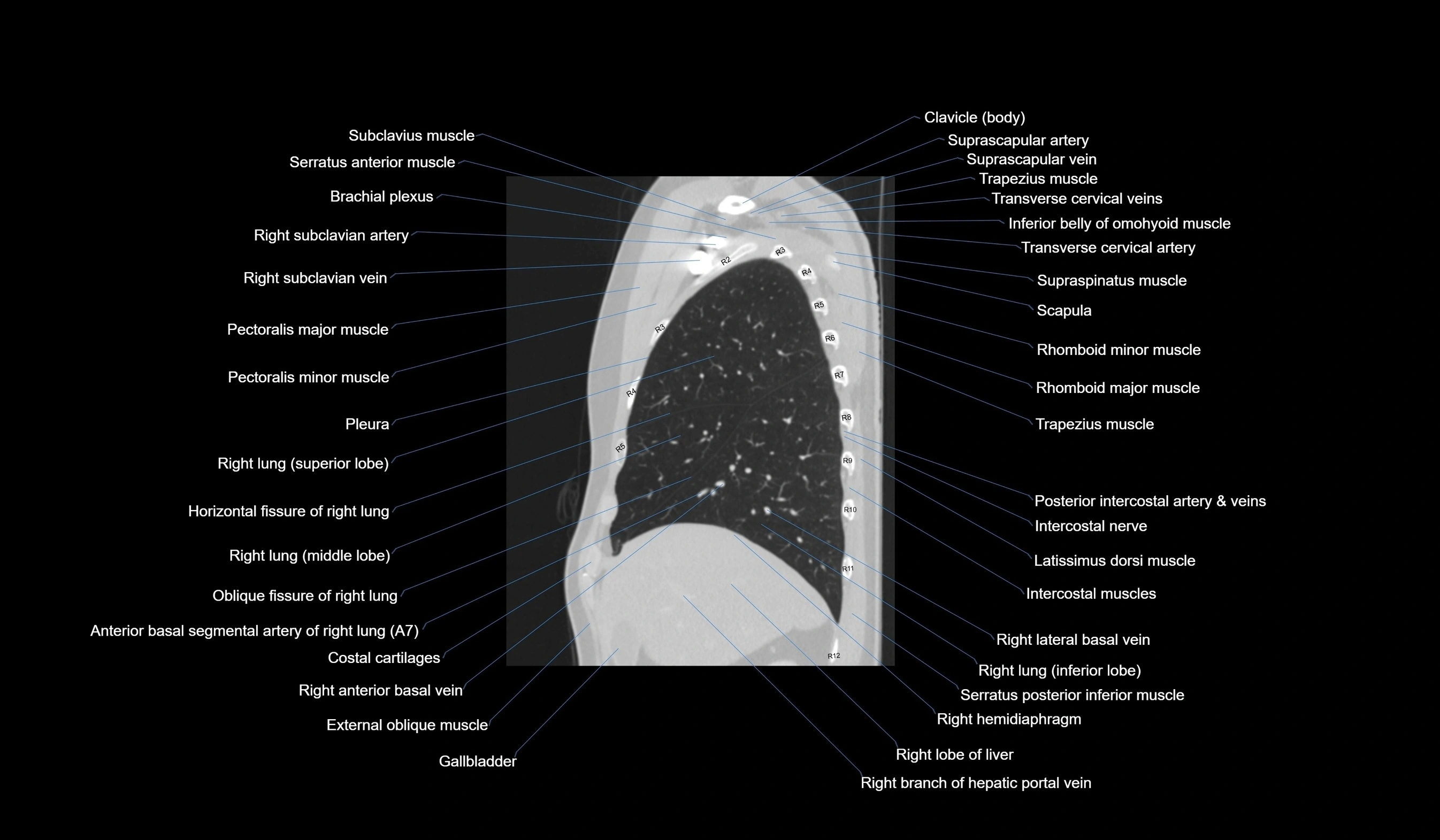 CT chest (thorax) labelled sagittal cross sectional anatomy radiology image-00038.webp